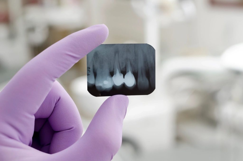 central jersey prosthodontics holding tooth x-ray